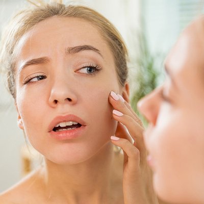 Mụn trứng cá đỏ (Rosacea) có đáng sợ như các nàng vẫn nghĩ?