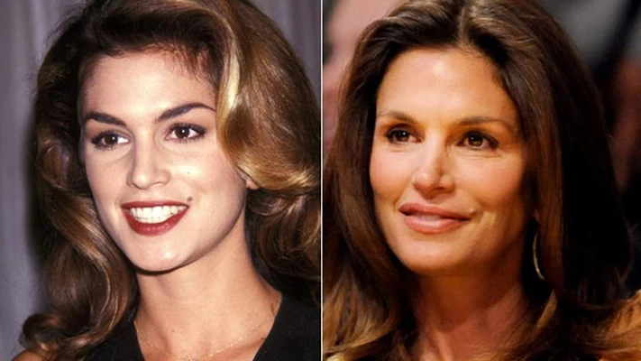 Khuôn mặt các sao trước và sau khi tiêm botox