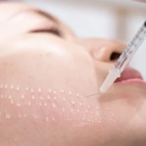Cái nhìn tổng quát về mesotherapy - phương pháp làm đẹp “hot” nhất hiện nay