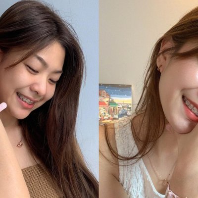 Niềng răng là bí quyết để có nụ cười rạng rỡ.