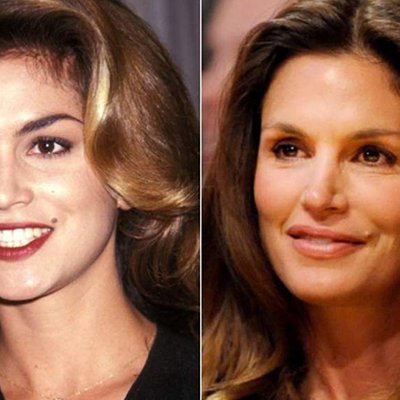 Khuôn mặt các sao trước và sau khi tiêm botox