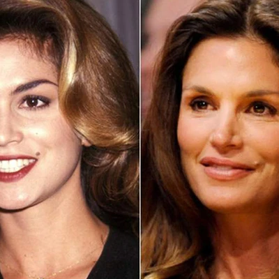 Khuôn mặt các sao trước và sau khi tiêm botox
