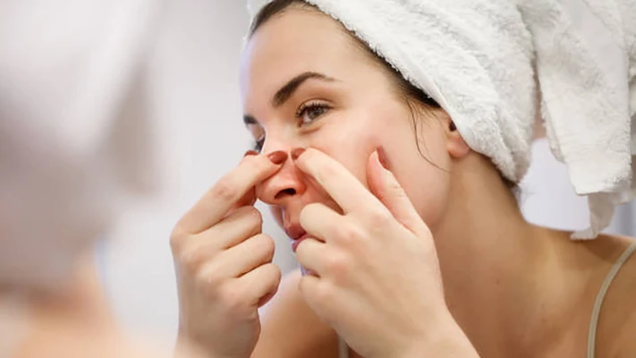 Các mẹo làm sạch mụn đầu đen hiệu quả