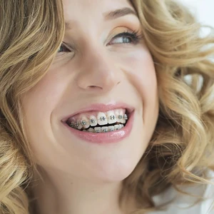 Nhật ký niềng răng: Cần chuẩn bị những gì trước khi chỉnh nha thẩm mỹ? (Phần 2)