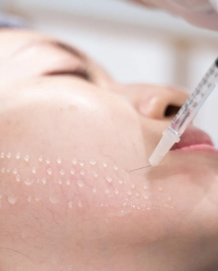 Cái nhìn tổng quát về mesotherapy - phương pháp làm đẹp “hot” nhất hiện nay