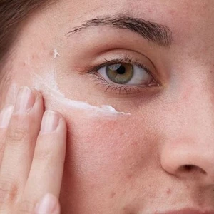 Chăm sóc da khi mắc Hội chứng buồng trứng đa nang PCOS