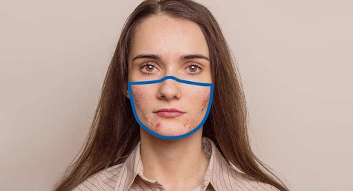 Maskne: thuật ngữ mới về làn da nổi mụn vì khẩu trang