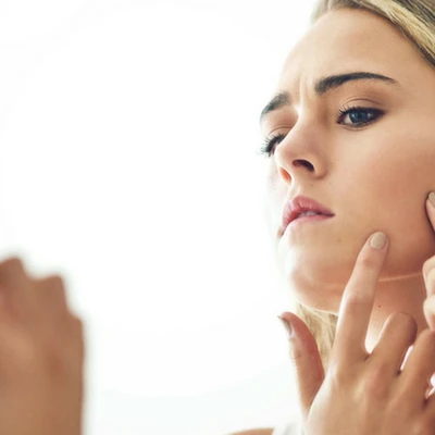 Các chuyên gia da liễu nói gì về mụn nội tiết?