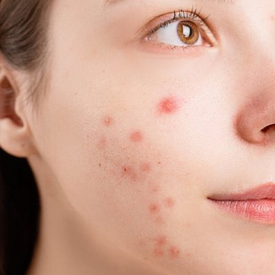 Retinol đối với da mụn