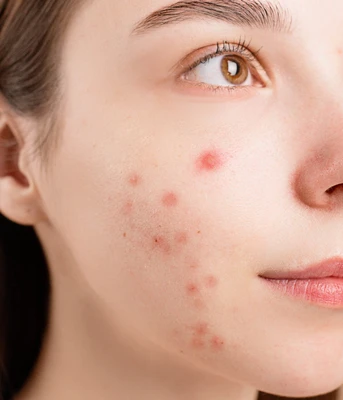 Retinol đối với da mụn