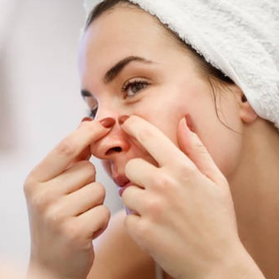 Các mẹo làm sạch mụn đầu đen hiệu quả