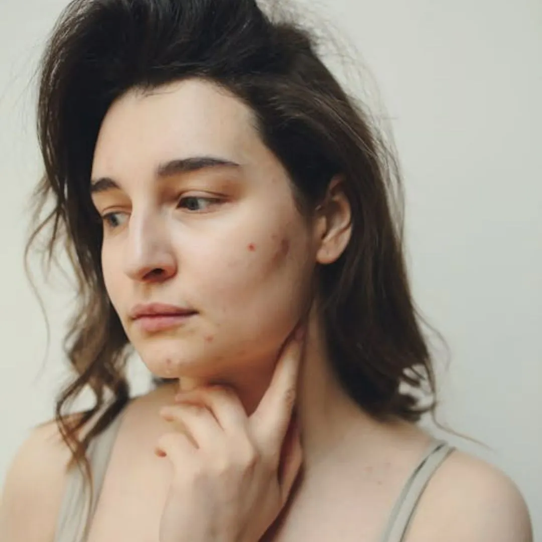 cô gái đang nổi mụn